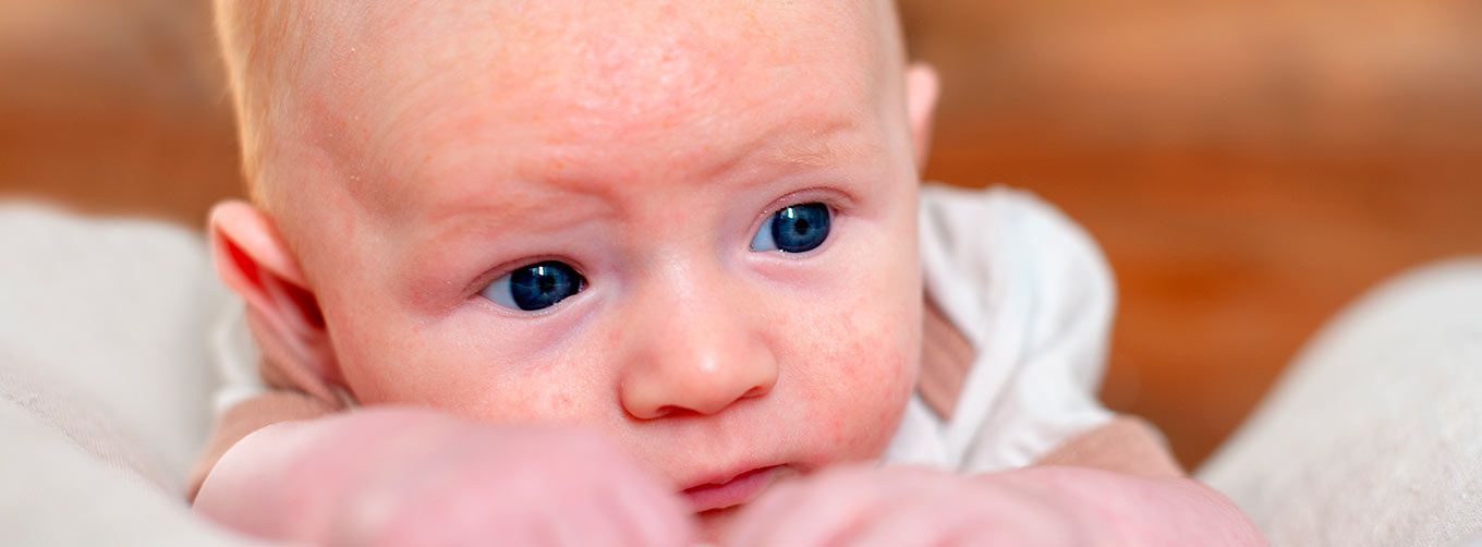 How to deal with baby eczema